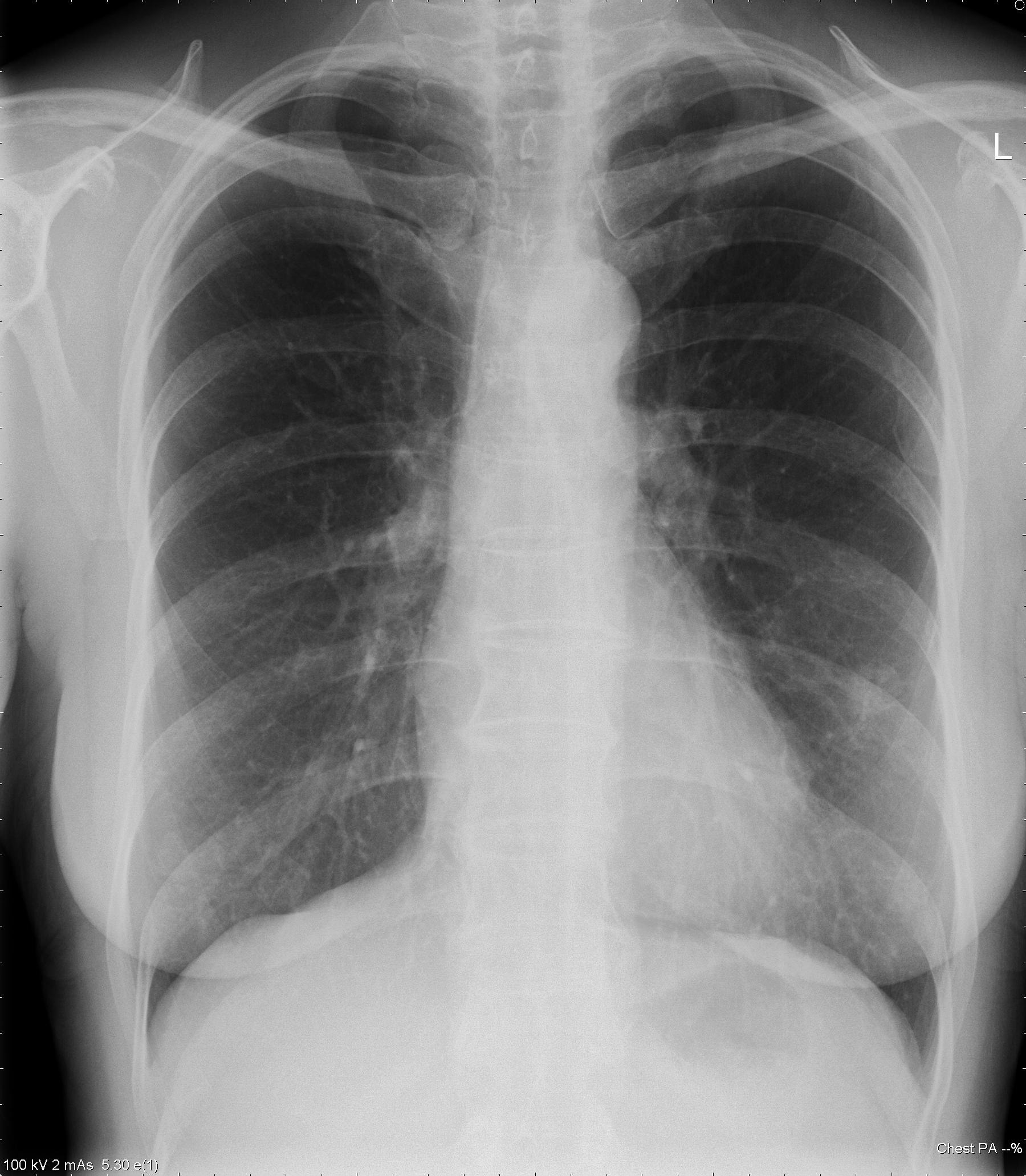 PtSD2 Congestive heart failure with Itraconazole Chest x ray May14
