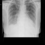 PtSD2 Congestive heart failure with Itraconazole Chest x ray Jan 14