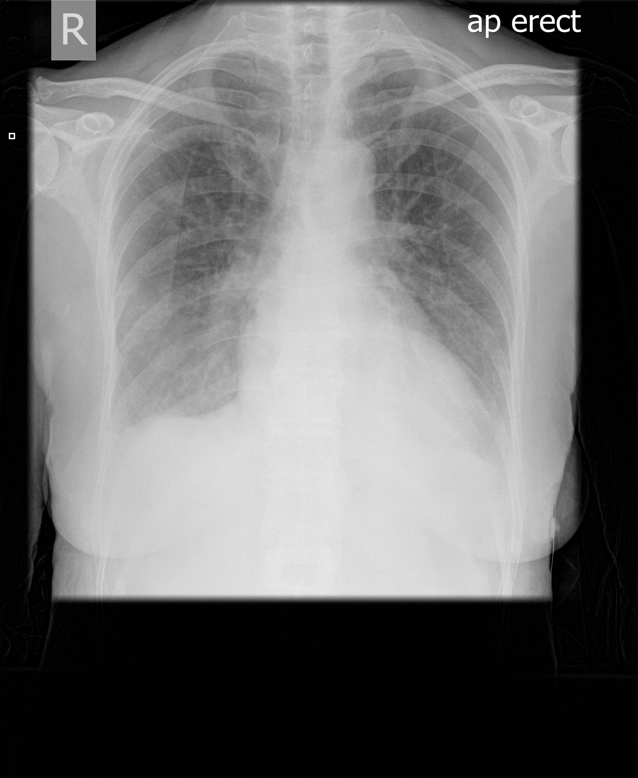 PtSD2 Congestive heart failure with Itraconazole Chest x ray Jan 14