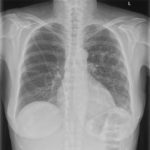 Chest Xray showing the normal course of a Hickman line