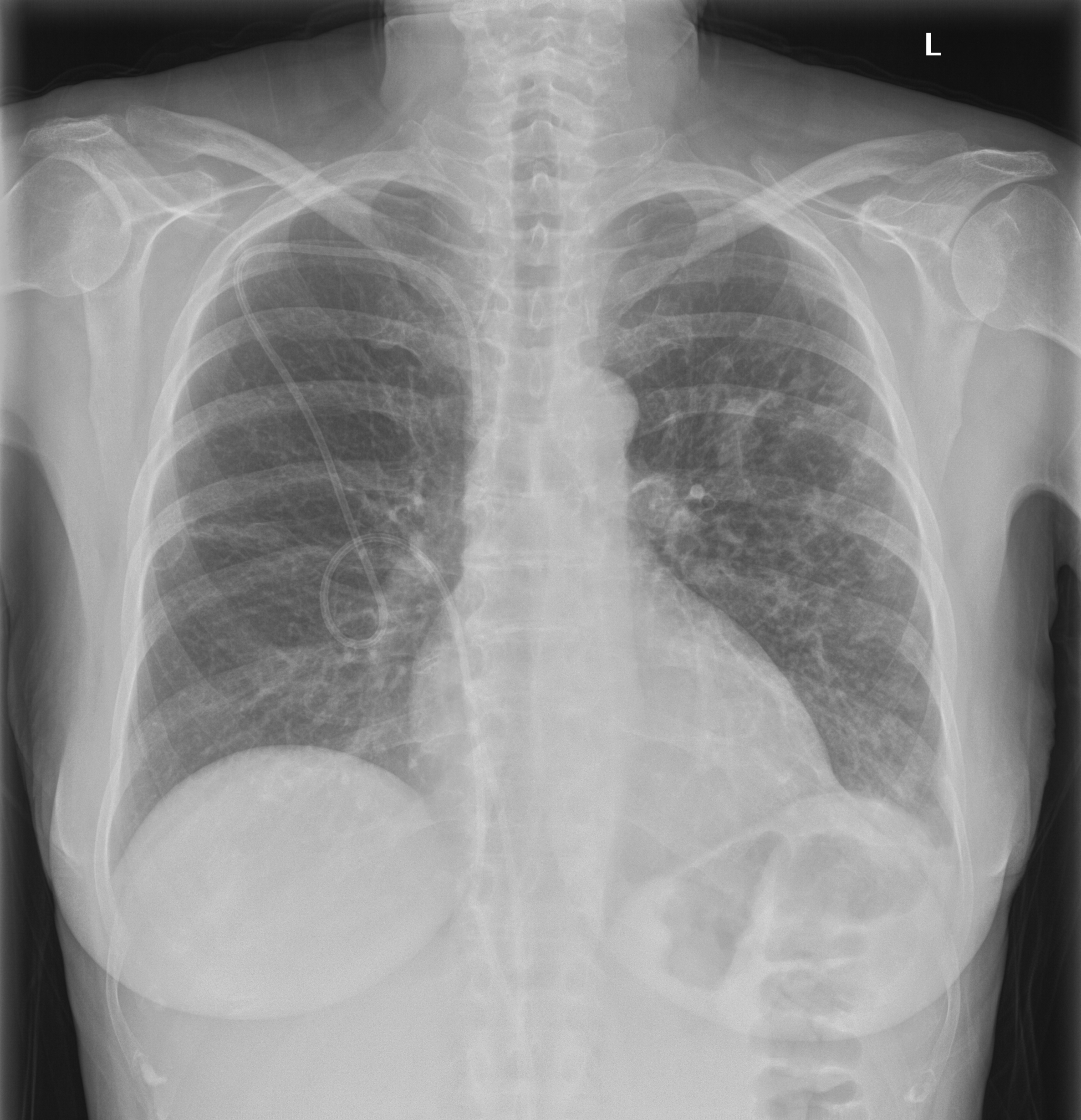 Chest Xray showing the normal course of a Hickman line