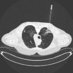 Percutaneous lung biopsy