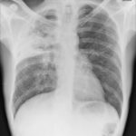 Pt DSM, Community acquired Aspergillus pneumonia 02/02/2010