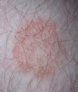 800px-Ringworm