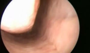 A normal endoscopy through the nose