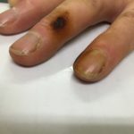 Nicotine stained fingers - image 2