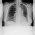 Patient YML ABPA and mucoid impaction Image 1