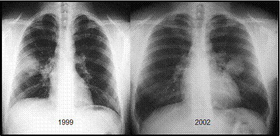 ABPA progression over 3 years