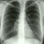 Image C. 09/08/96 Post CT scan and treatment.Resolution of right middle lobe collapse, with residual streaky markings in the right lower lobe. 