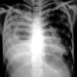 Image C. IPA in chronic granulomatous disease, Pt, JA