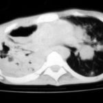 Image B. IPA in chronic granulomatous disease, Pt, JA