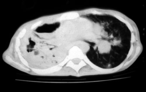 Image B. IPA in chronic granulomatous disease, Pt, JA