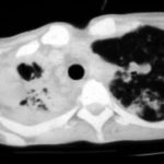 Image D. IPA in chronic granulomatous disease, Pt, JA