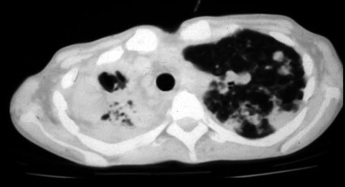 Image D. IPA in chronic granulomatous disease, Pt, JA