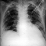 Image B. Diffuse bilateral nodular IPA in AIDS, pt JA