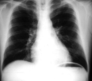 This chest radiograph was taken immediately after bronchoscopy and shows major improvement.