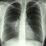 Image B. 18/4/96 Chest X-ray of pt JO post bronchoscopy. Increased shadowing is seen in the right mid zone, consistent with right middle lobe collapse and consolidation.