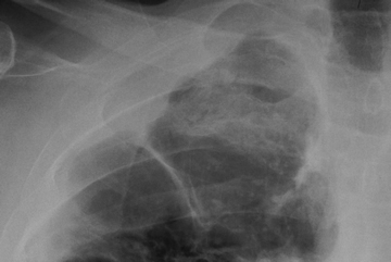 Image B. Chest xray 7/1/05 Close up of cavity in upper right lobe 