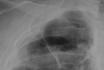 Image H. Chest xray 22/9/06 Close up of upper right cavity