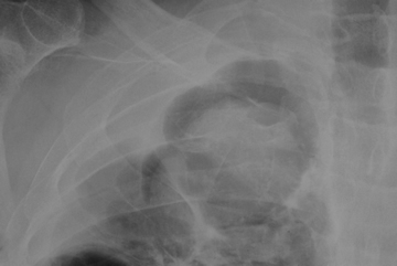 Image F. Chest xray 19/5/06 Close up of upper right cavity