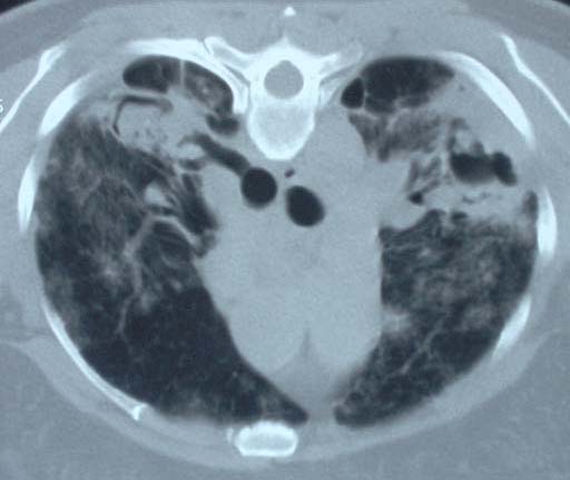 Image B. Sarcoidosis with 2 cavities containing aspergilloma patient DB