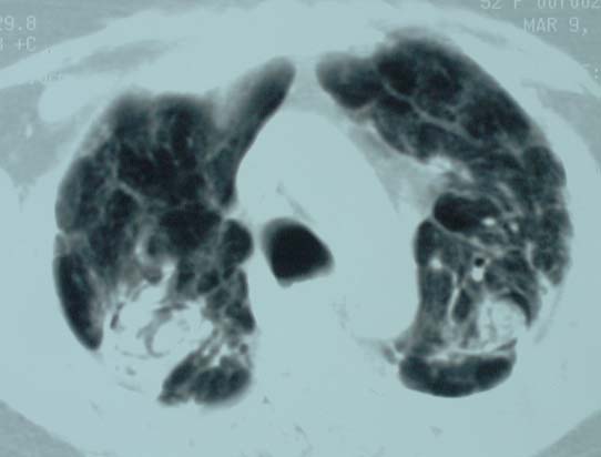 Image C. Progession of aspergilloma (?CIPA) in sarcoidosis, patient DB.