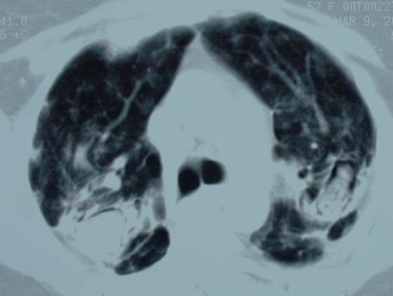 Image E. Progession of aspergilloma (?CIPA) in sarcoidosis, patient DB.