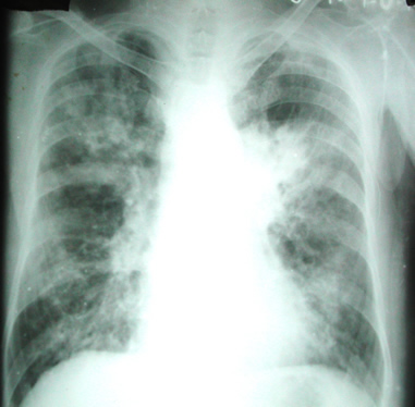 Chest X-ray 10 days prior to admission 