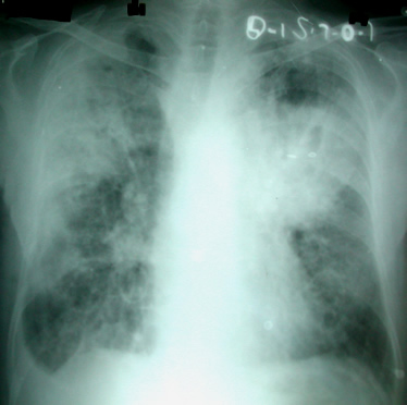 Chest x ray of patient 4 days prior to admission