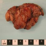 Image F. Partial lung resection with visible lung bullae