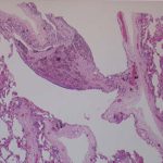 Image H. Histology of lung sections showing large bullae (spaces). 