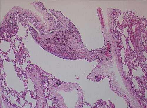 Image H. Histology of lung sections showing large bullae (spaces). 