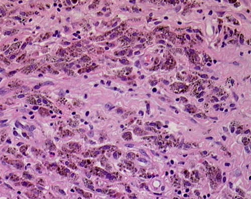 Image J. Histology shows accumulation of dark-pigmented alveolar macrophages.