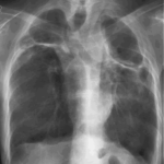 Chest X Ray 27/02/01