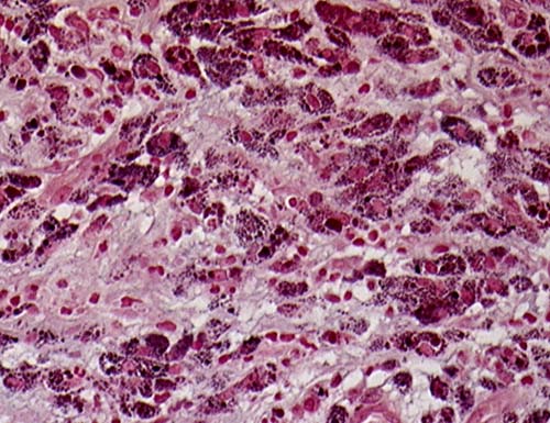 Image I. Histology shows accumulation of dark-pigmented alveolar macrophages.