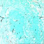 Image Q. 4/4/96  Microscopic appearance of bronchial plug pt JO (Gomori methenamine silver stain (GMS)).