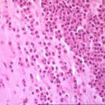 Image P. 4/4/96  Microscopic appearance of bronchial plug pt JO (H&E stain).