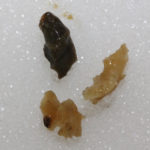 September 2011 More pneumoliths representing probable clinical failure