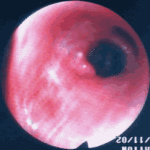 The plug has been removed piecemeal by suction through a wide channel bronchoscope and the orifice is now unblocked. The underlying mucosa is extremely inflammed.