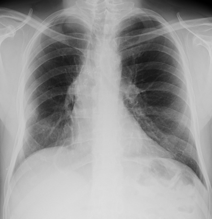 Image 7 28/08/09 In june 09 the patient underwent surgical resection of the right upper lobe. This subsequent X- ray was clear.
