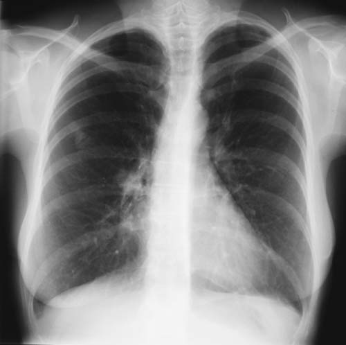Image E. 03/98 Near complete resolution with corticosteroid treatment