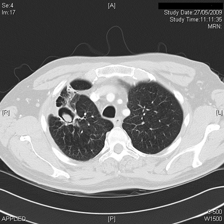 Image 6 27/05/09 Ct scan (2) 
