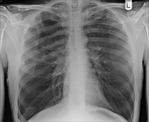 Image B. Late February 2009 – persistent apical bullae right upper zone with resolving pneumothorax.  Chest drain still in-situ.  Increasing right upper lobe shadowing possibly representing infection or haemorrhage.