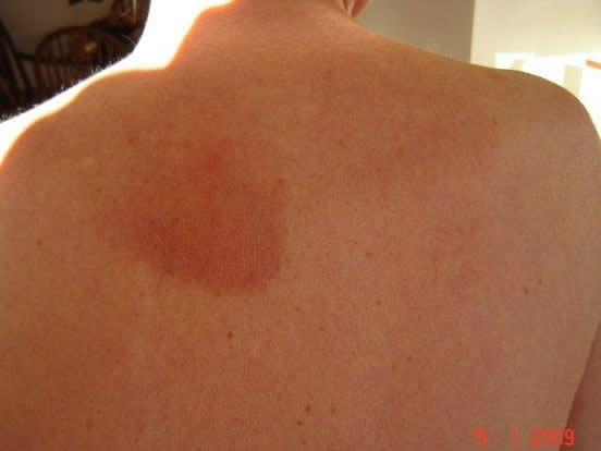Image D: Papular rash with blisters on the back, associated with CPA but prior to treatment, rash appeared 2 years previously in October 2007. The rash resolved on treatment with azoles.