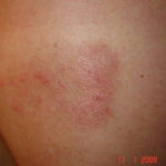 Image C: Papular rash with blisters on the back, associated with CPA but prior to treatment, rash appeared 2 years previously in October 2007. The rash resolved on treatment with azoles.