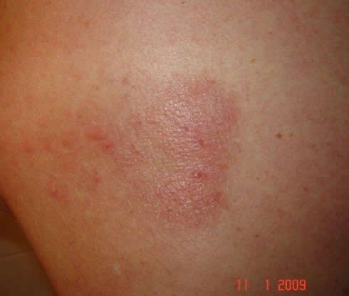 Image C: Papular rash with blisters on the back, associated with CPA but prior to treatment, rash appeared 2 years previously in October 2007. The rash resolved on treatment with azoles.