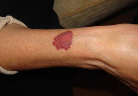 Image A: Red skin rash on arms due to effect of inhaled steroids termed ecchymosis.