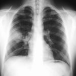 Image B. 29/9/99 FEV1 = 1.6. IgE=3000 RAST=52.5. Rx  atypical pneumonia (FEV1=3.3 post antibiotics) 