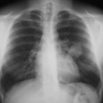 Image D.19/03/02 FEV1=3.4.IgE=2220 RAST=36 Rx antibiotics 