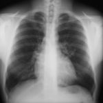 Image E. 28/05/02 Failed to attend for 18 months. Diagnosed ABPA.RAST 52. Short course pred. FEV1=5.1 